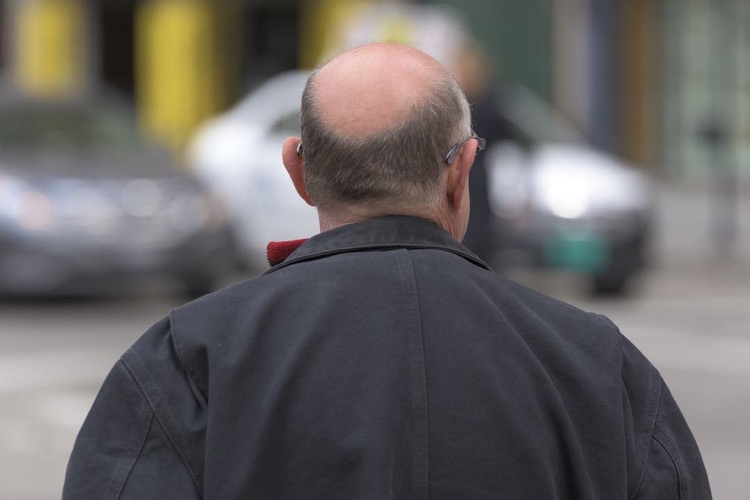 trapianto di capelli