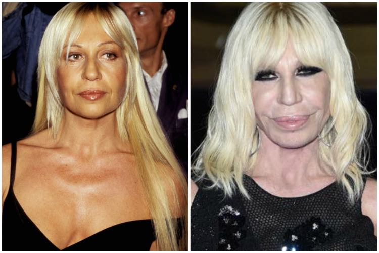 donatella versace disastri chirurgia