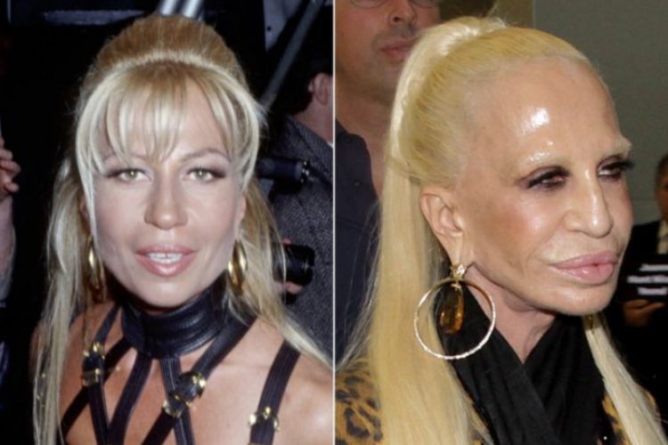 donatella versace disastri chirurgia