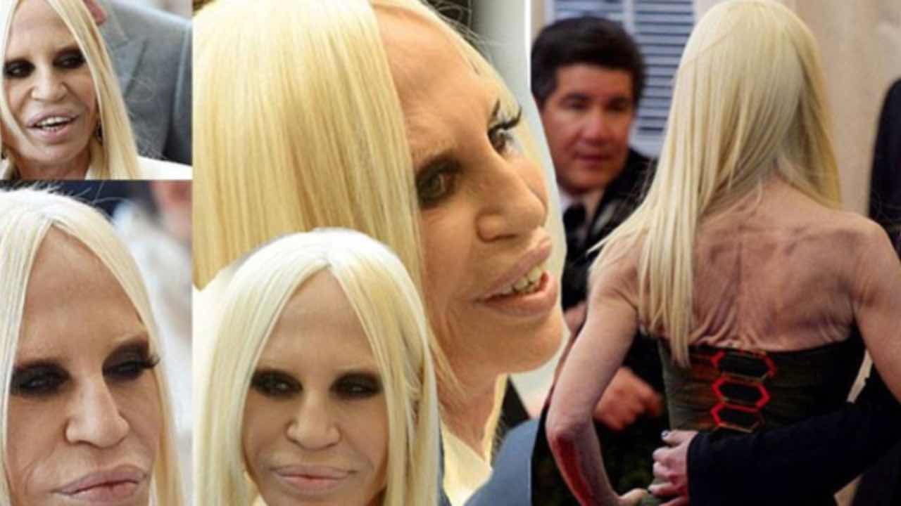 donatella versace disastri chirurgia