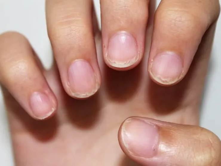 Le unghie fragili sono un campanello d'allarme del colesterolo (fonte web) topicnews.it